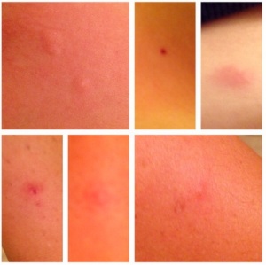 Just a few of the dozen or so mosquito bites I got within 24 hours in North Carolina